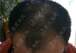脫發10年是怎么恢復的？八字方針：外治頭皮，內調氣血