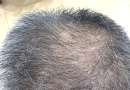 51歲，脫發20年是怎么恢復的？