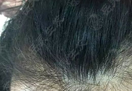 與白發(fā)say no！50歲白發(fā)60%是怎樣轉(zhuǎn)黑的