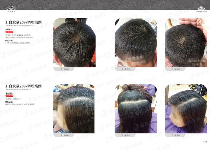 小孩有白頭發是缺什么東西