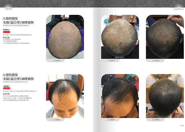 男性脫發的癥狀及脫發原因
