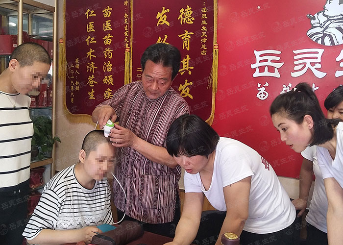 什么是永久性脫發及產生原因