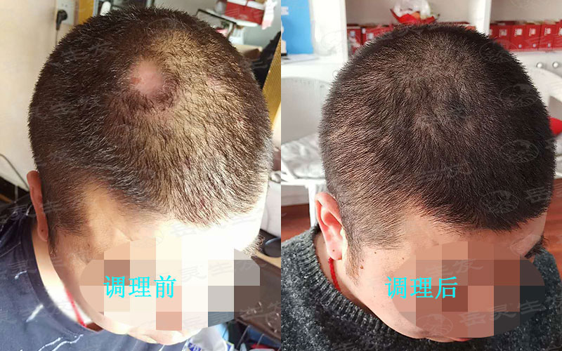 判斷脫發的方法有哪些