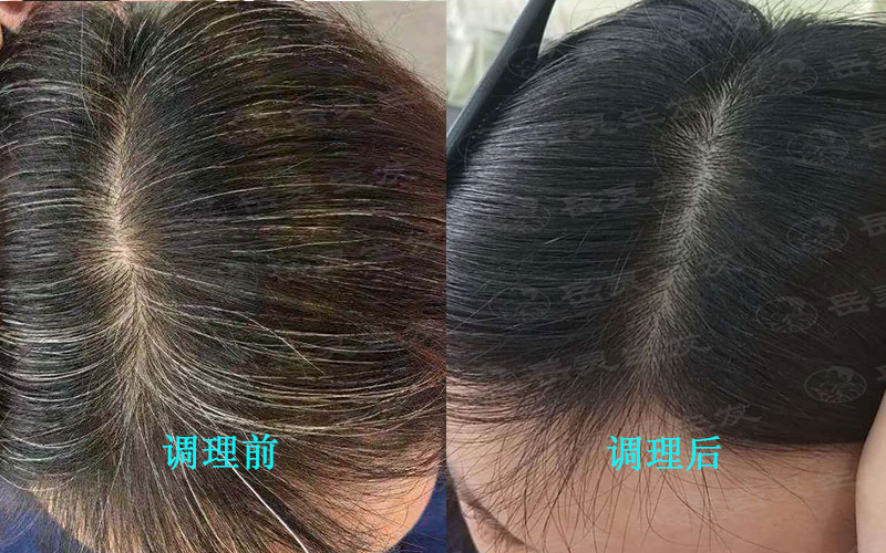 白頭發變黑發的調理方法有哪些?