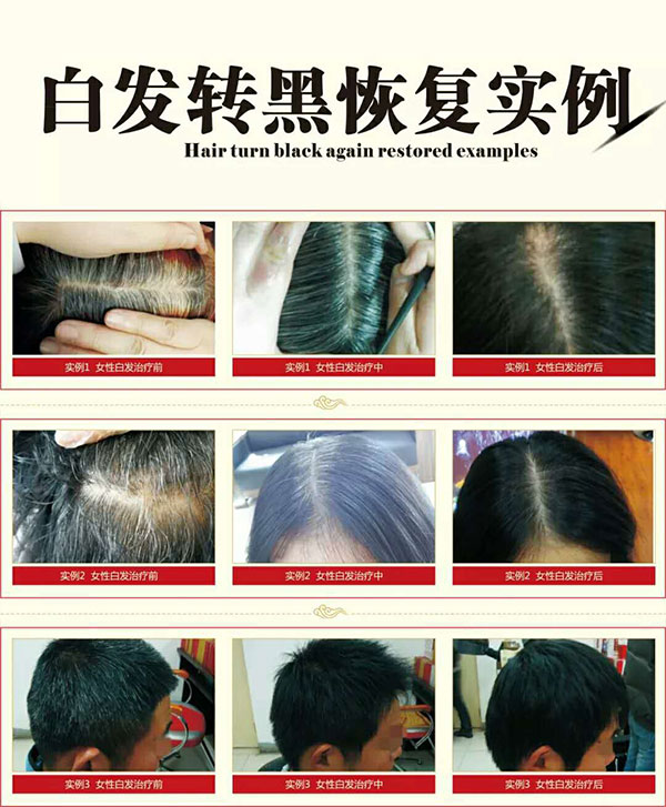 什么生發方法能夠擺脫白發