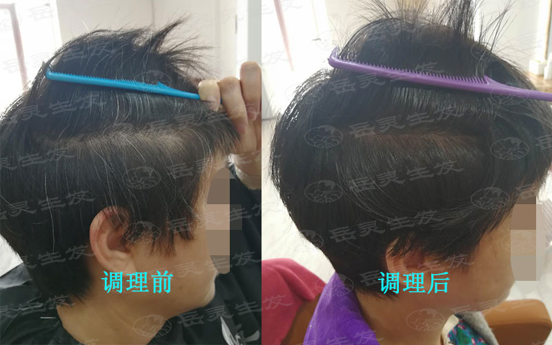 年輕人應該如何調理預防白發
