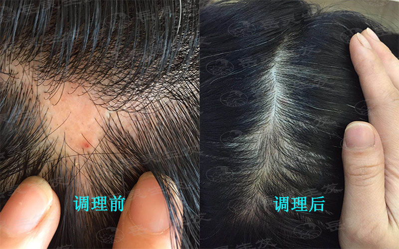 如何養發生發能起到防脫發的效果