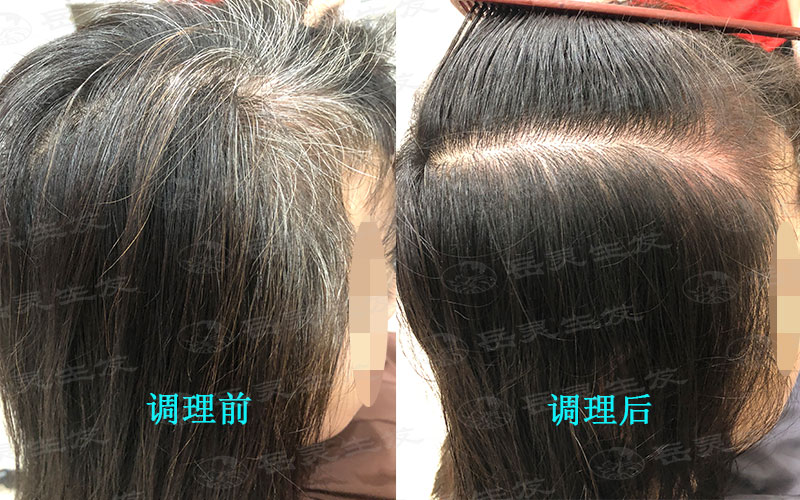 擺脫白發從健康生發調理做起