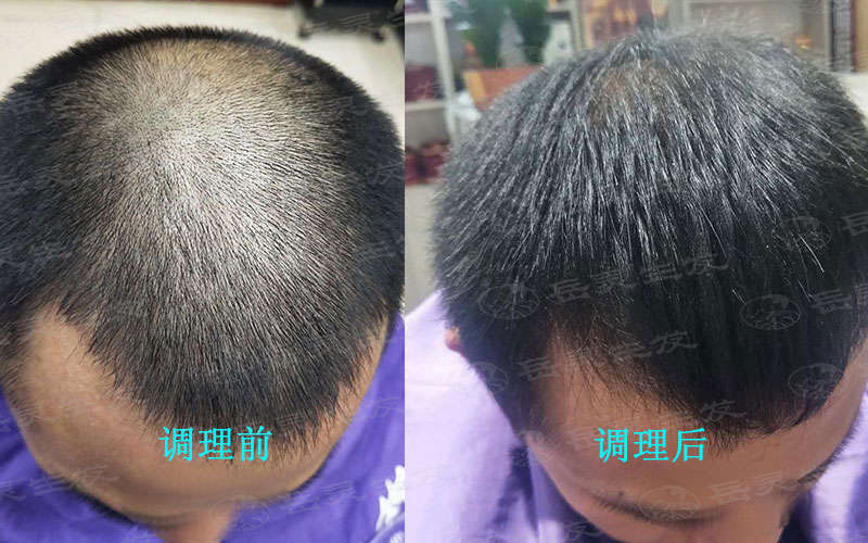 脫發的原因與如何去調理生發