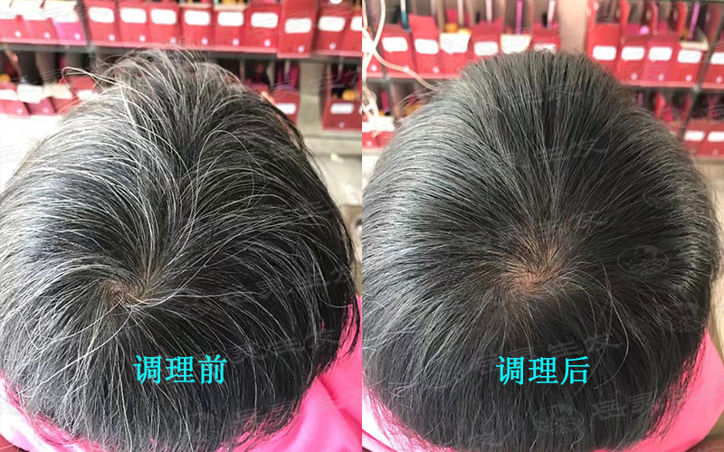 長白發的原因你都知道嗎?