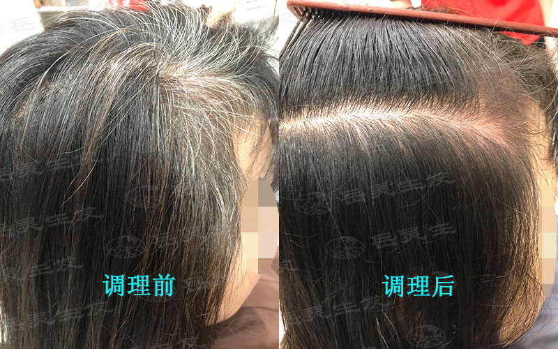 為什么小孩有白發?該如何養發?