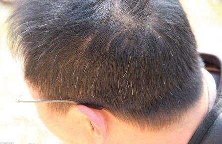 白發是缺什么?如何養發才能轉黑?