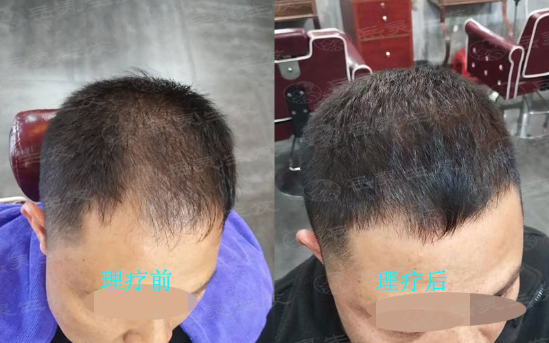 我們防脫生發的養發護發注意事項