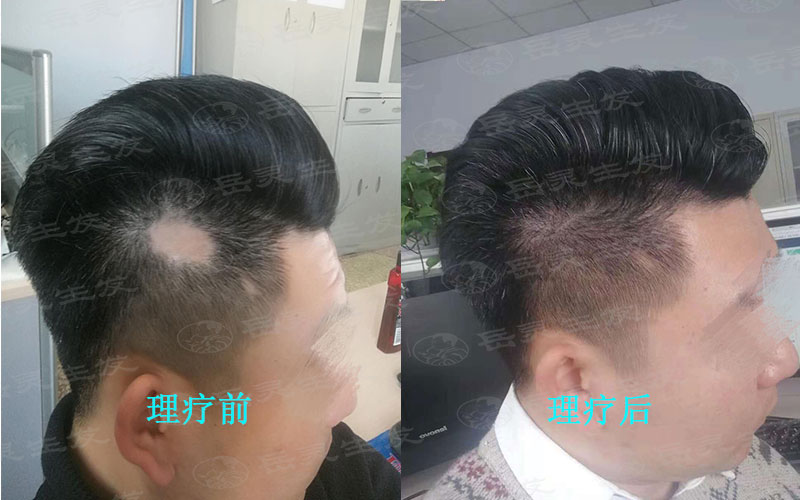想要防脫發我們該如何養發護發