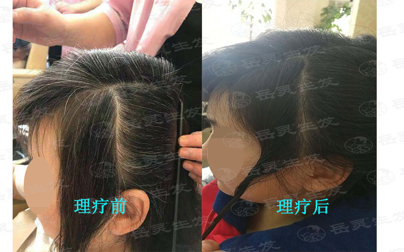 少白頭變黑我們該如何養發護發