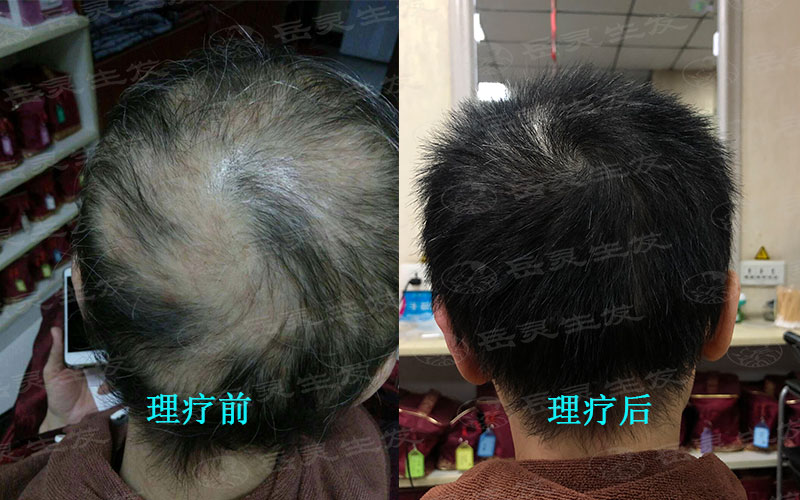 防脫生發的養發方法有哪些