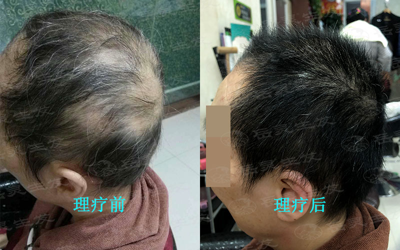 食療養發對于防脫發是很重要的