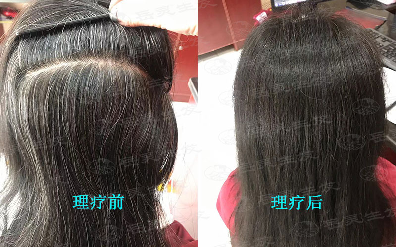 白發轉黑發不同原因有不同養發方法