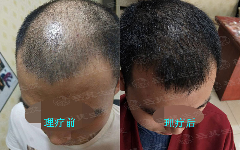 如何更好的防脫發你真的知道嗎？