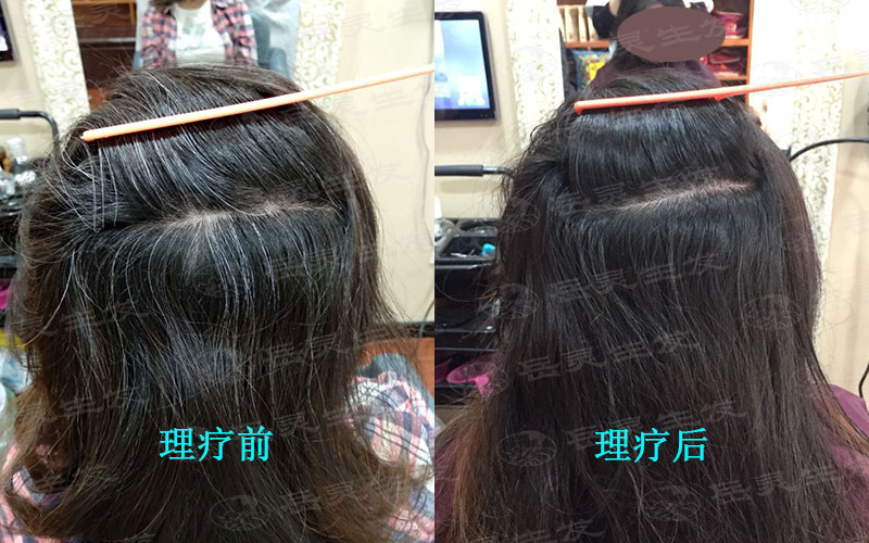 少年白發轉黑發要先知道其中的原因