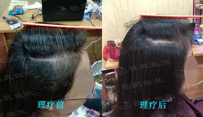 發現了白頭發該如何養發護發呢