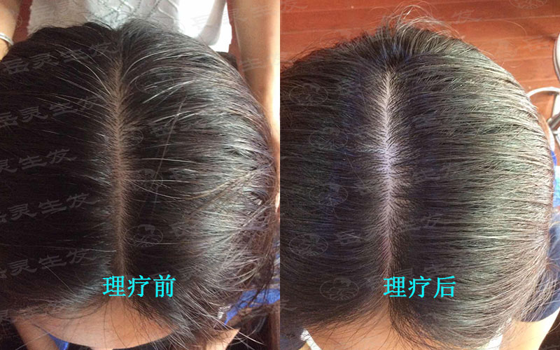 長白頭發的原因及轉黑發的方法