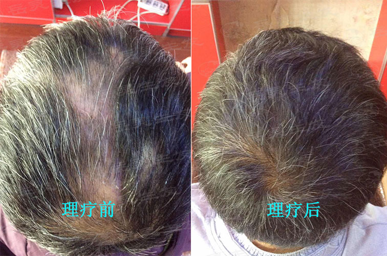 長期失眠會導致脫發(fā)嗎？