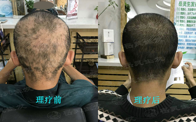中年男人防脫生發的養發護發事項