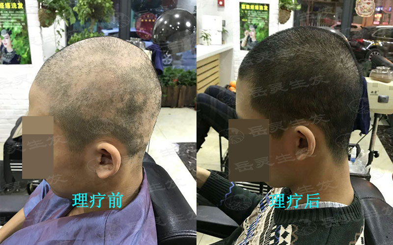 什么是神經(jīng)性脫發(fā)大家知道嗎？