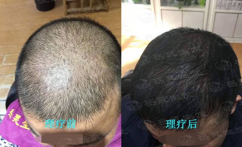 面對長期的脫發(fā)該怎么辦？