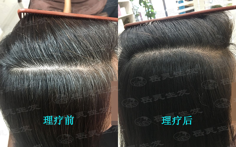 想讓白發轉黑發的養發措施