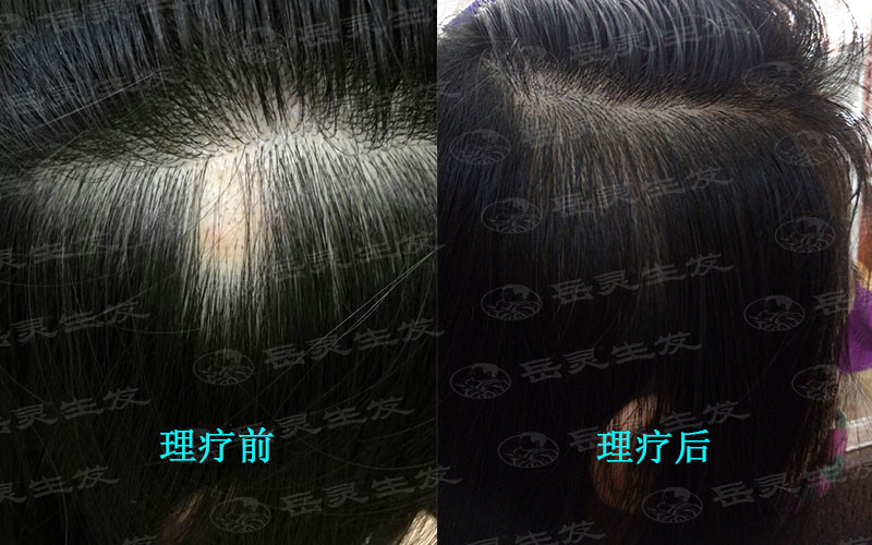 促進血液循環達到止脫生發