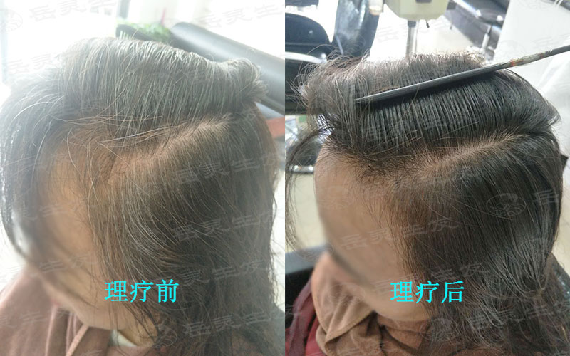 白頭發是剪是拔?如何才能變黑?