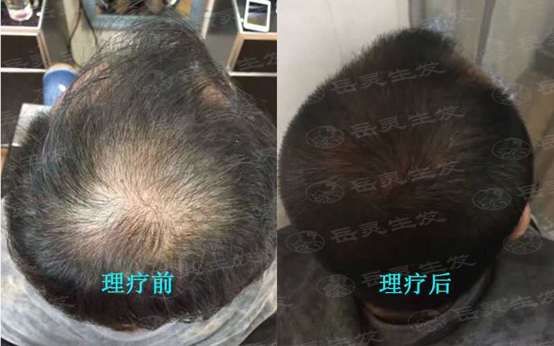 防脫生發中正確的梳發也是關鍵