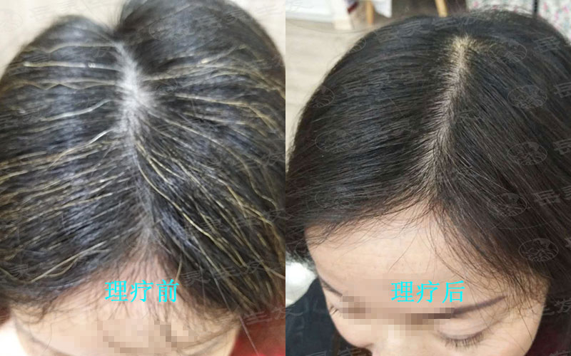 出現白發的原因及預防的方法