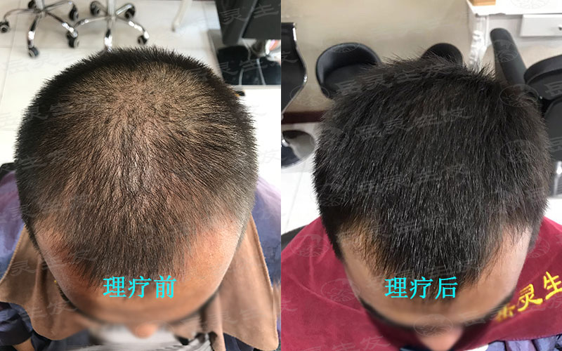 為什么秋天容易脫發?我們該如何養發?