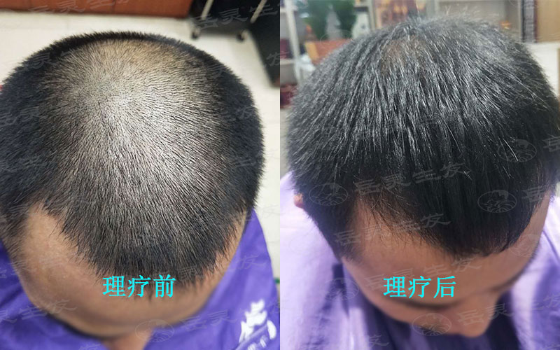 秋季日常脫發的四種原因
