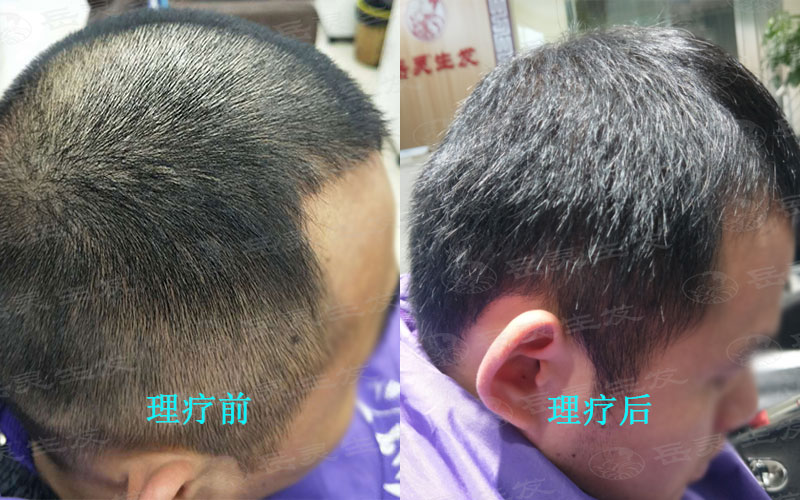 秋季養發是預防脫發的季節