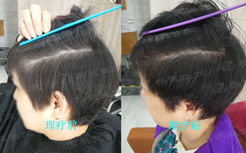 為什么會有白發的原因