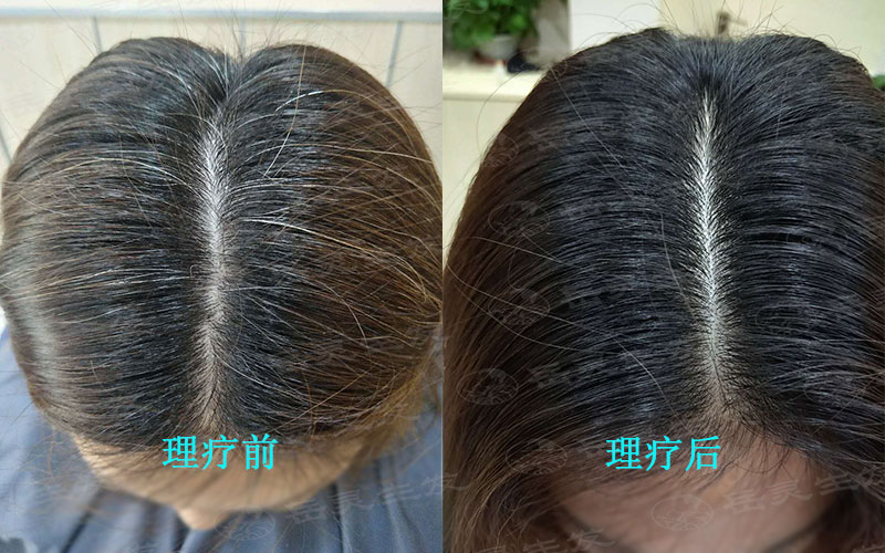 白發變黑發的成功的方法