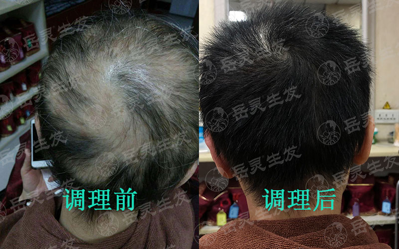 擺脫脫發吃什么生發養發的食物