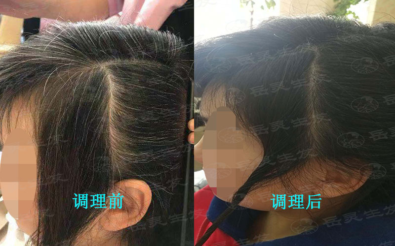 少白頭變黑發的養發方法