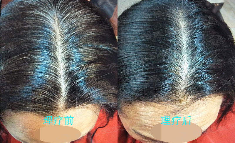 白頭發變黑你要清楚的事項