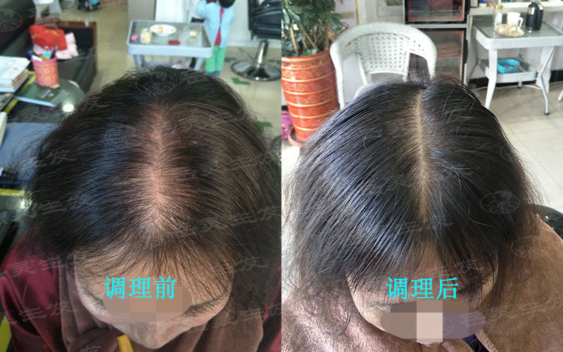 如何防脫生發?怎么養發效果好?