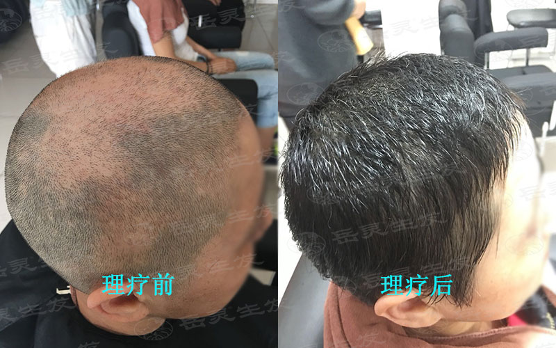 什么防脫生發方法能阻止突發性掉發