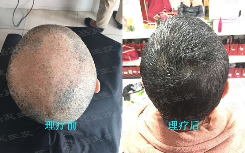 防脫生發要有正確的養發方法