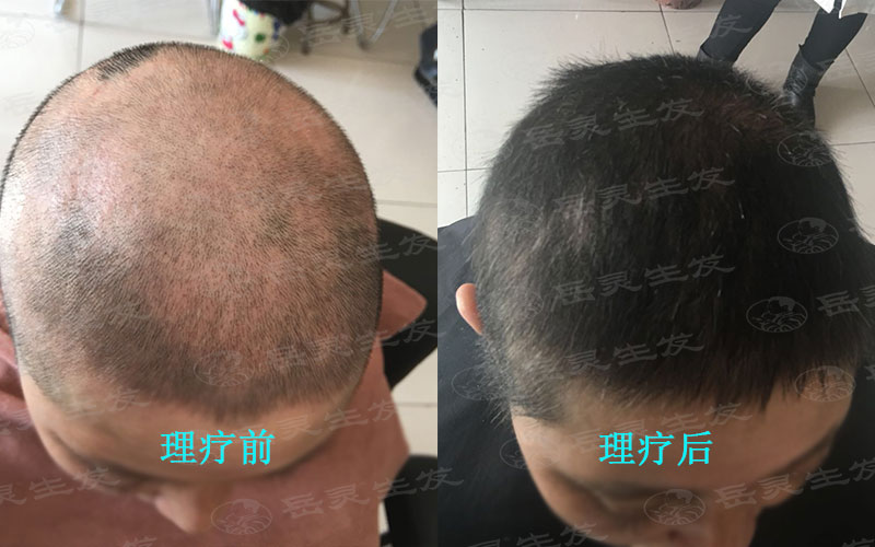 怎樣防脫生發能擺脫經常掉頭發