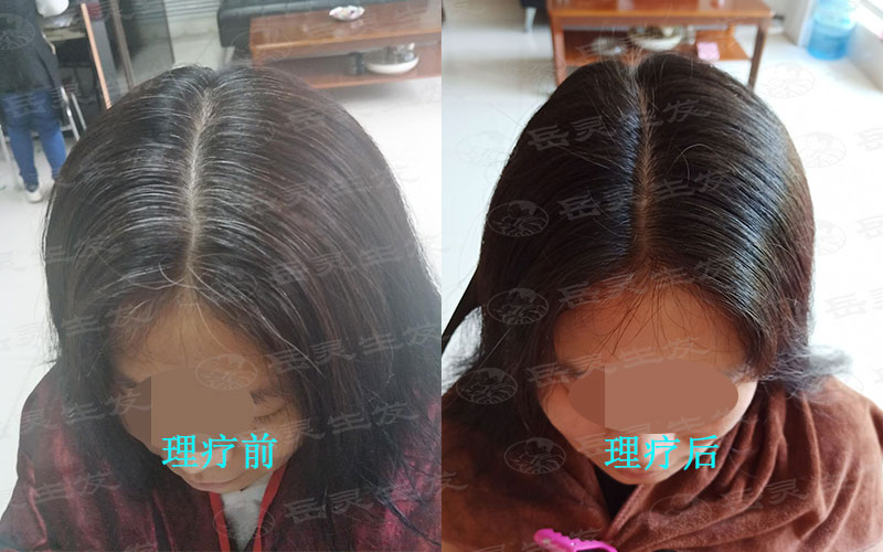 什么辦法能夠將白發轉黑發