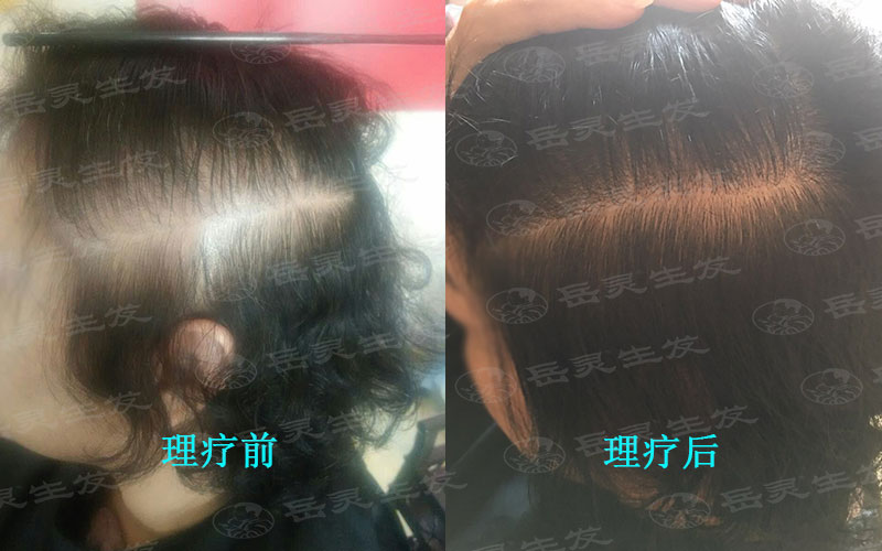 真正脫發的五大征兆警惕你健康養發