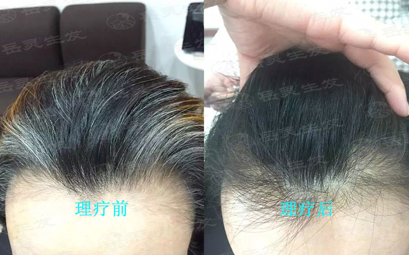 如何讓白發轉黑發你知道嗎?